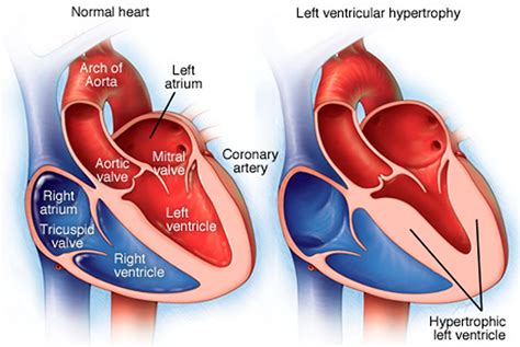 lv pressure overload|is hyperdynamic left ventricle dangerous.